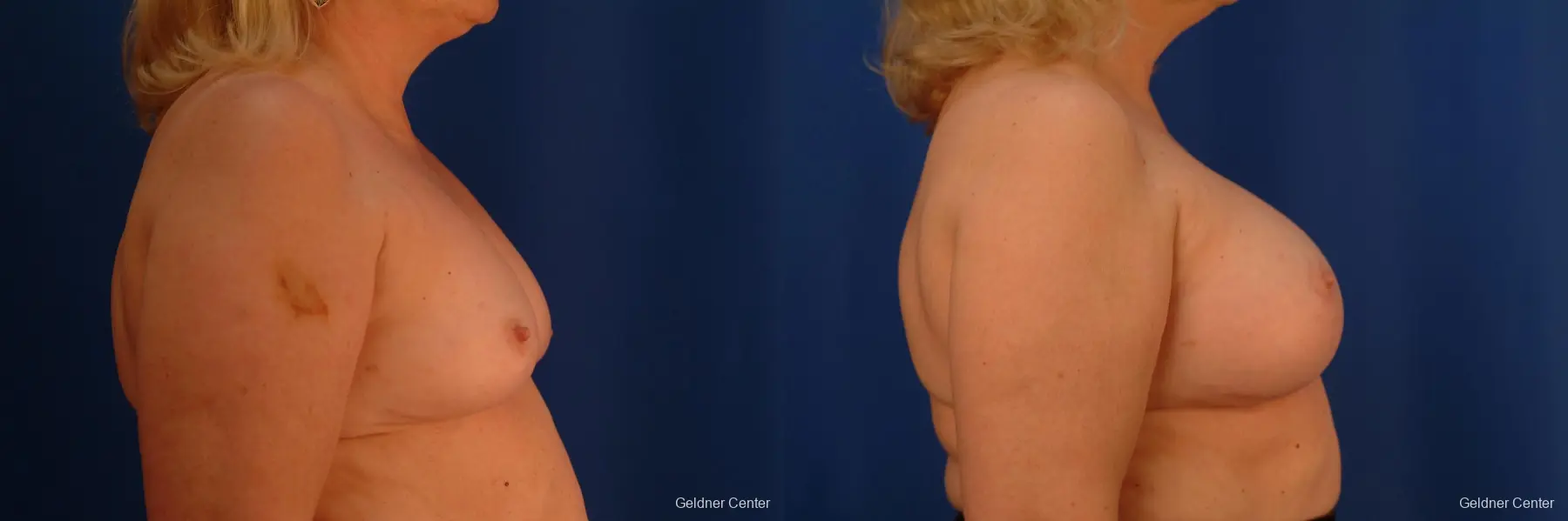 Chicago Breast Augmentation 2429 - Before and After 2