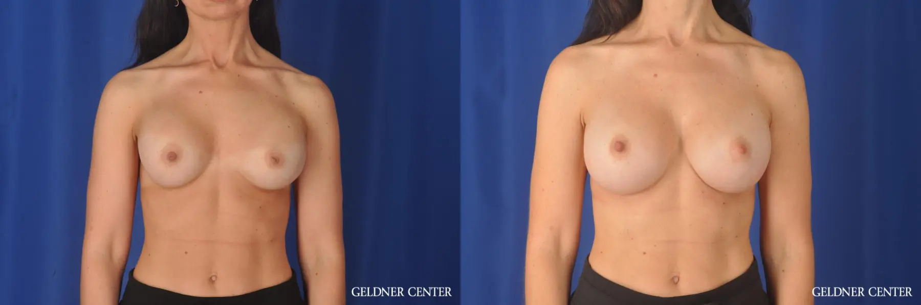Breast Augmentation: Patient 142 - Before and After 1