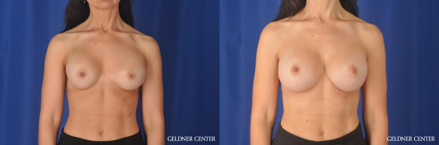 Secondary Biplanar Subpectoral Breast Augmentaion 350cc - Before and After