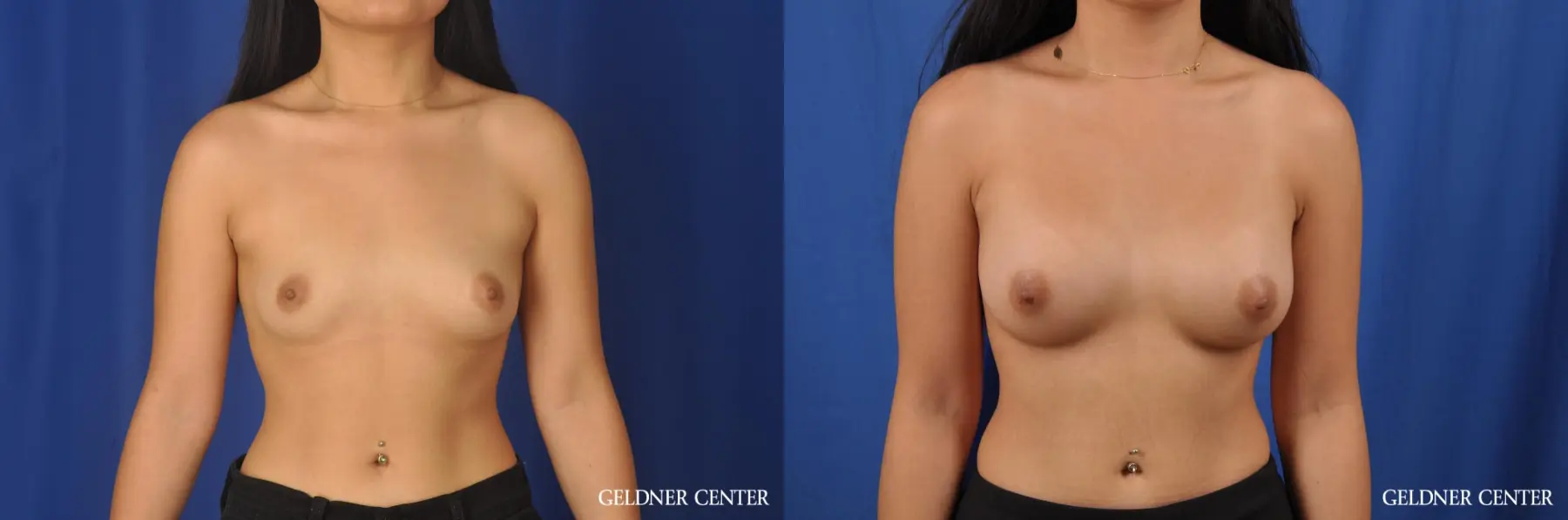 Biplanar Subpectoral Transaxillary 300cc - Before and After