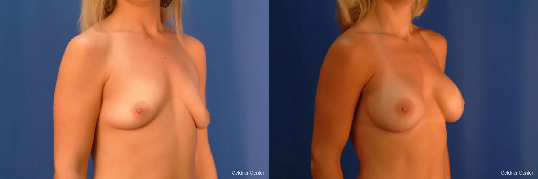 Breast Augmentation Lake Shore Dr, Chicago 2350 - Before and After 3