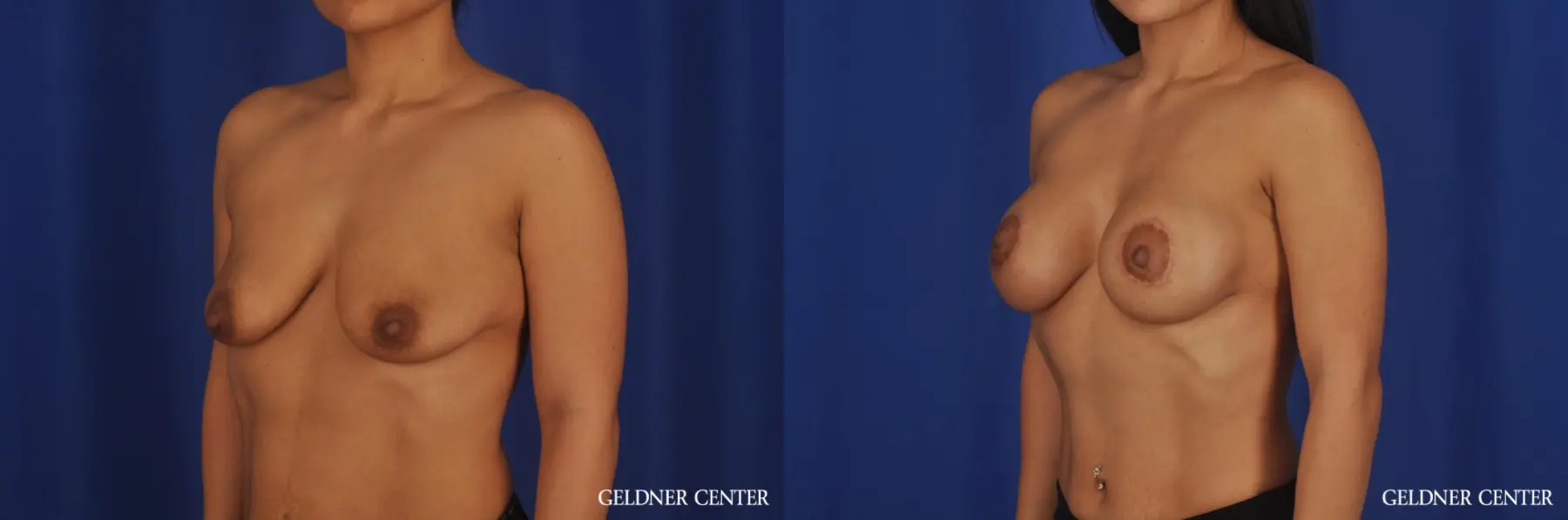 Breast Augmentation: Patient 186 - Before and After 4