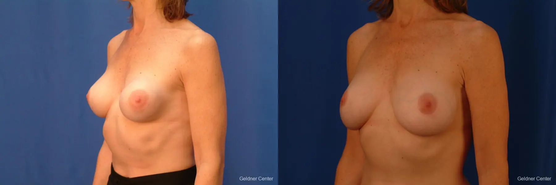 Chicago Breast Augmentation 2444 - Before and After 4