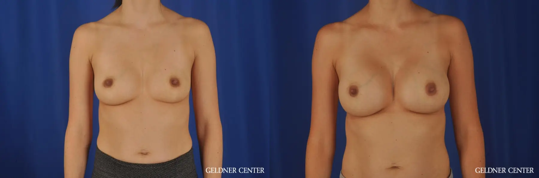 Chicago Breast Augmentation 8818 - Before and After