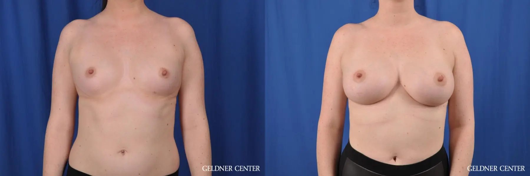 Biplanar Submuscular 400cc - Before and After