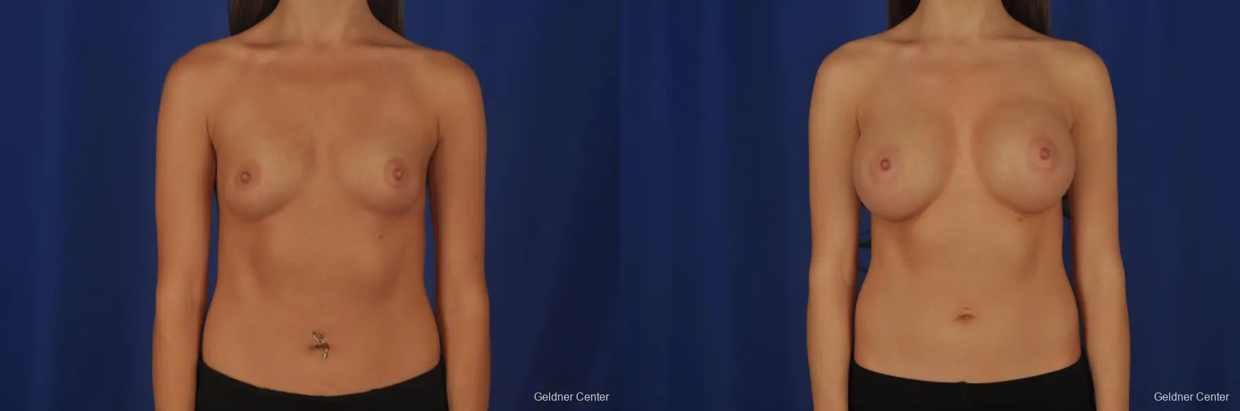 Breast Augmentation Hinsdale, Chicago 2373 - Before and After