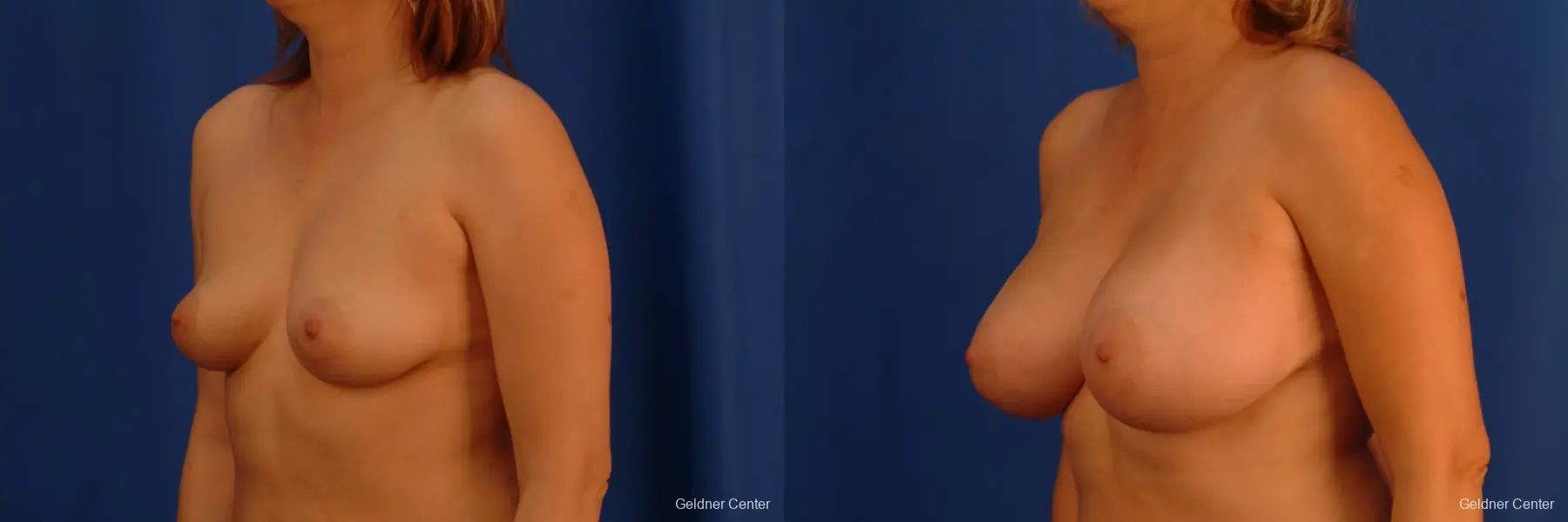 Chicago Breast Augmentation 2532 - Before and After 4