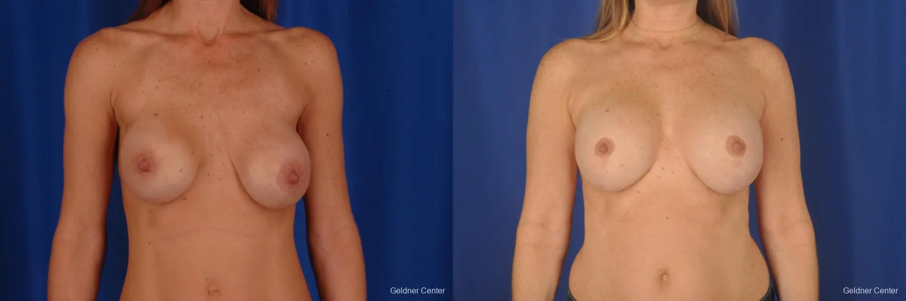 biplanar subglandular with a vertical mastopexy - Before and After