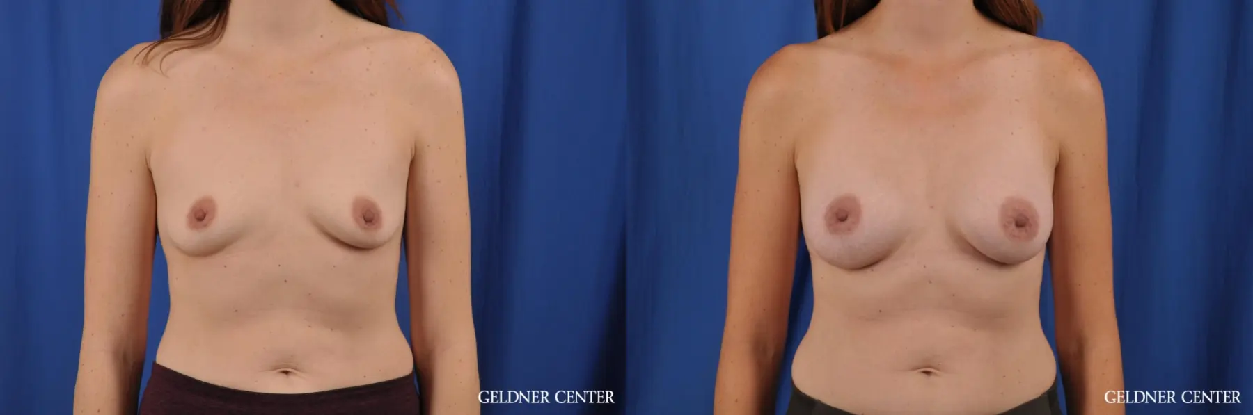 biplanar subpectoral breast augmentation 250cc - Before and After