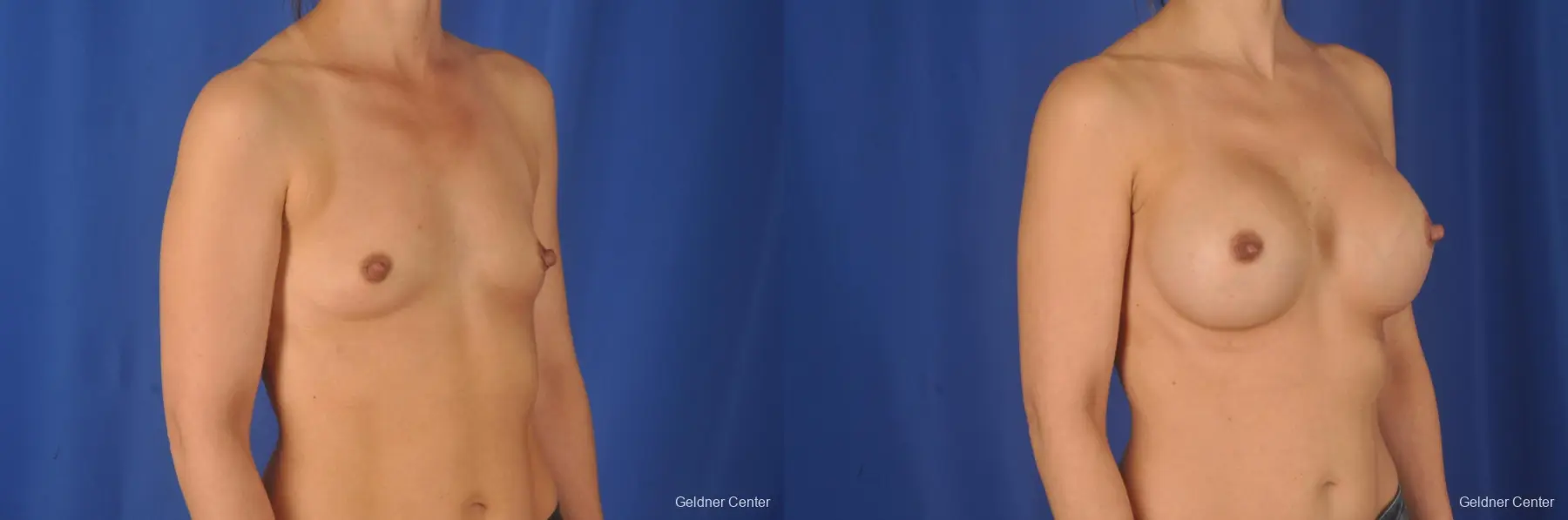 Breast Augmentation: Patient 78 - Before and After 2