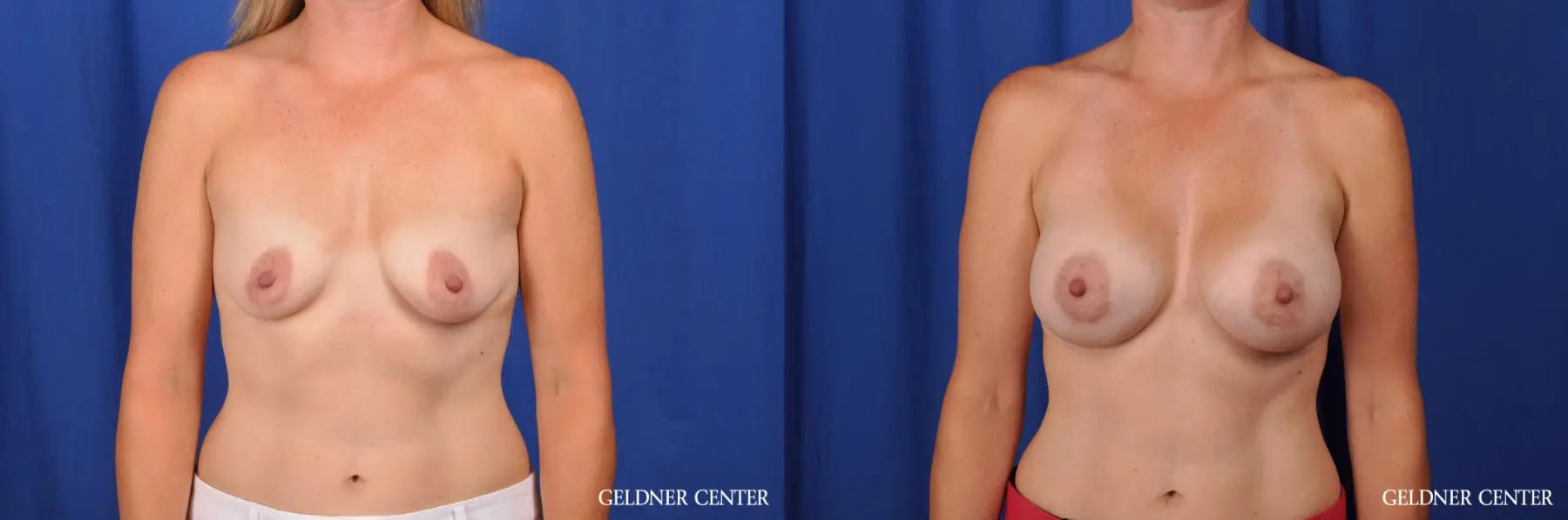 Breast Augmentation Hinsdale, Chicago 5580 - Before and After