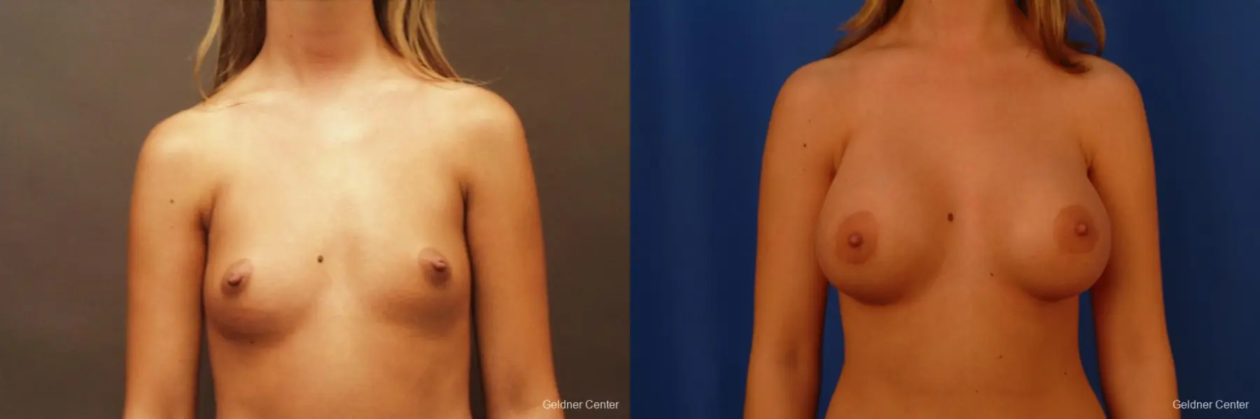 Breast Augmentation Lake Shore Dr, Chicago 2533 - Before and After 1