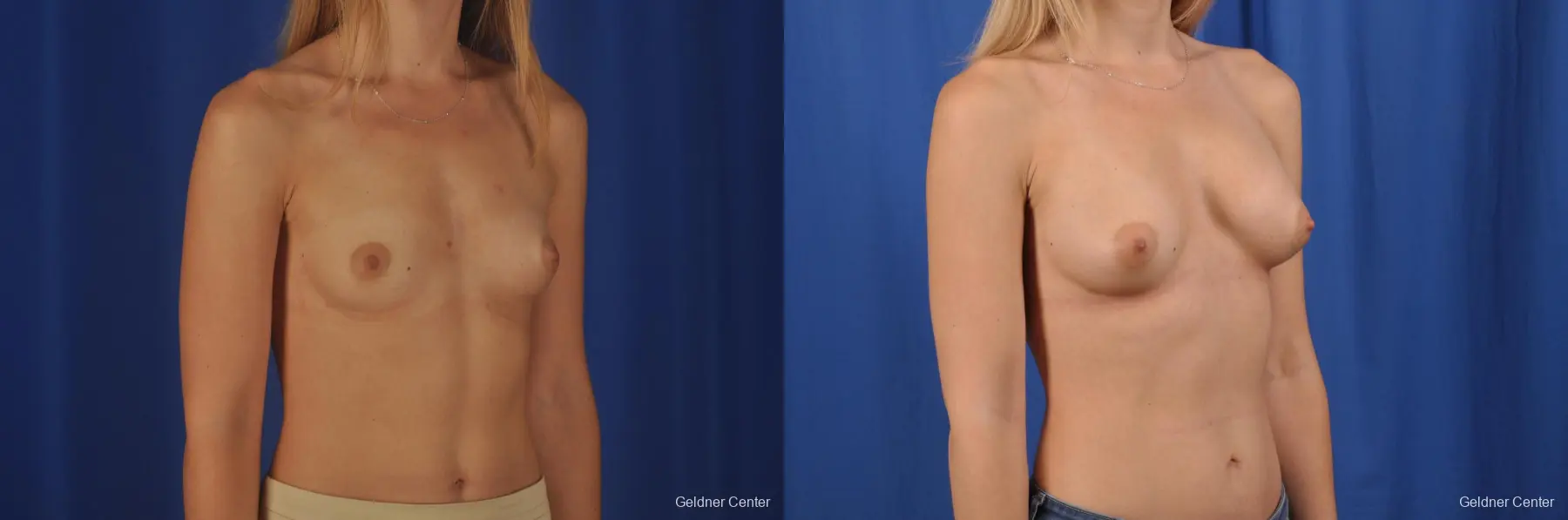 Breast Augmentation: Patient 150 - Before and After 2