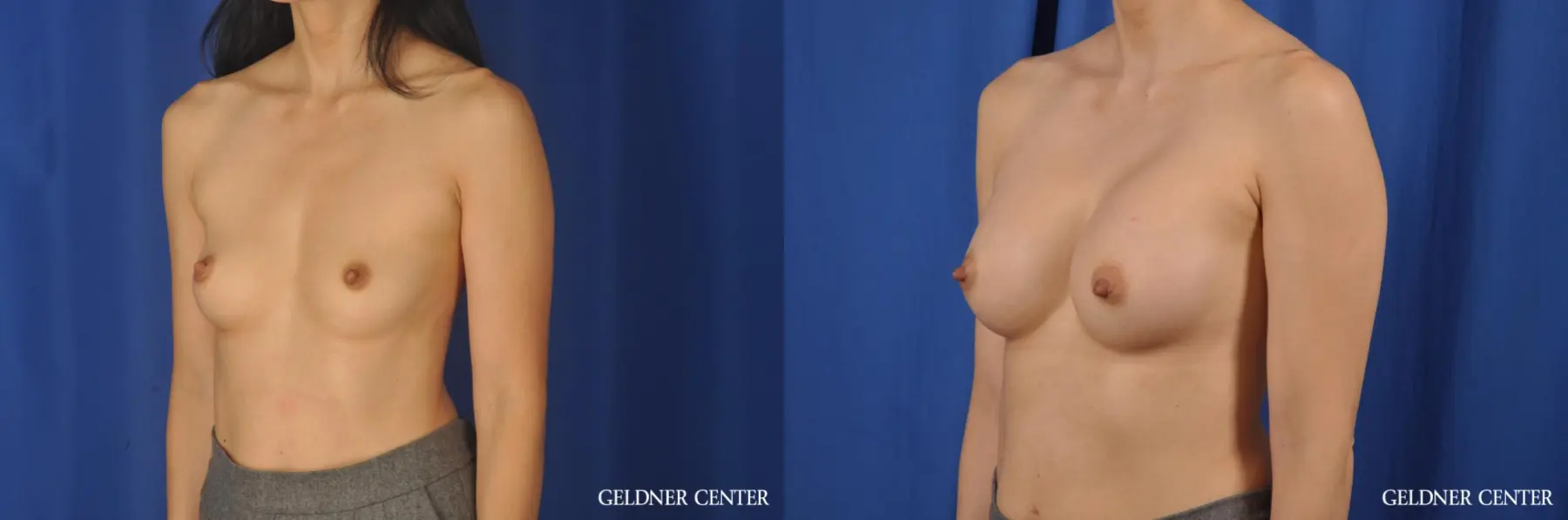 Breast Augmentation: Patient 177 - Before and After 4