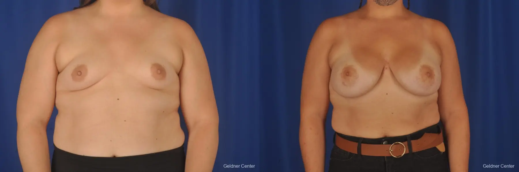 Breast Augmentation: Patient 190 - Before and After 1
