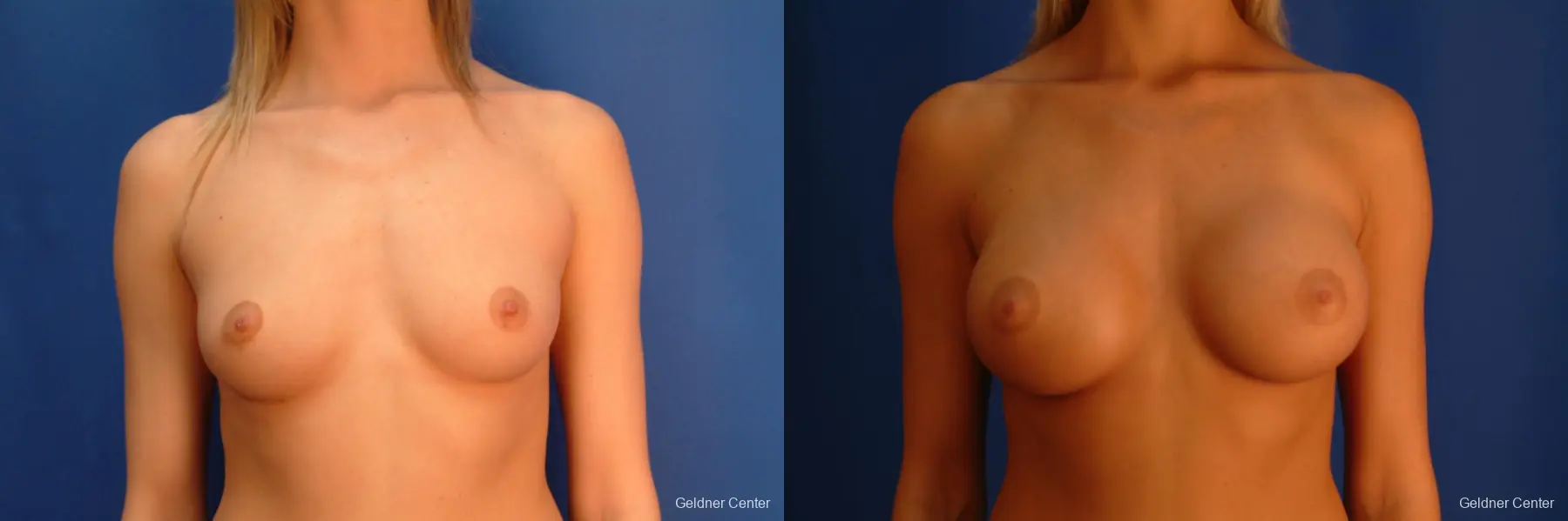 Chicago Breast Augmentation 2523 - Before and After 1