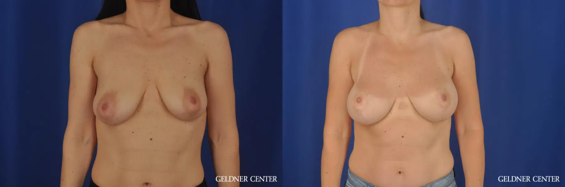 Chicago Breast Augmentation 6655 - Before and After