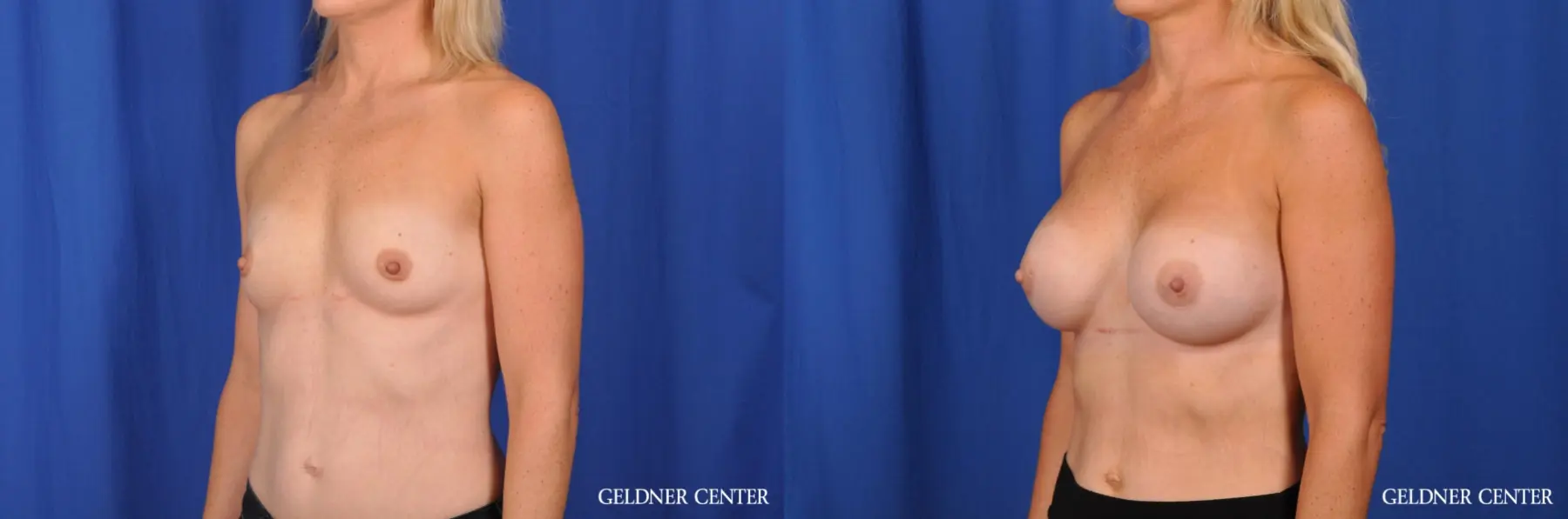 Chicago Breast Augmentation: Patient 1 - Before and After 4