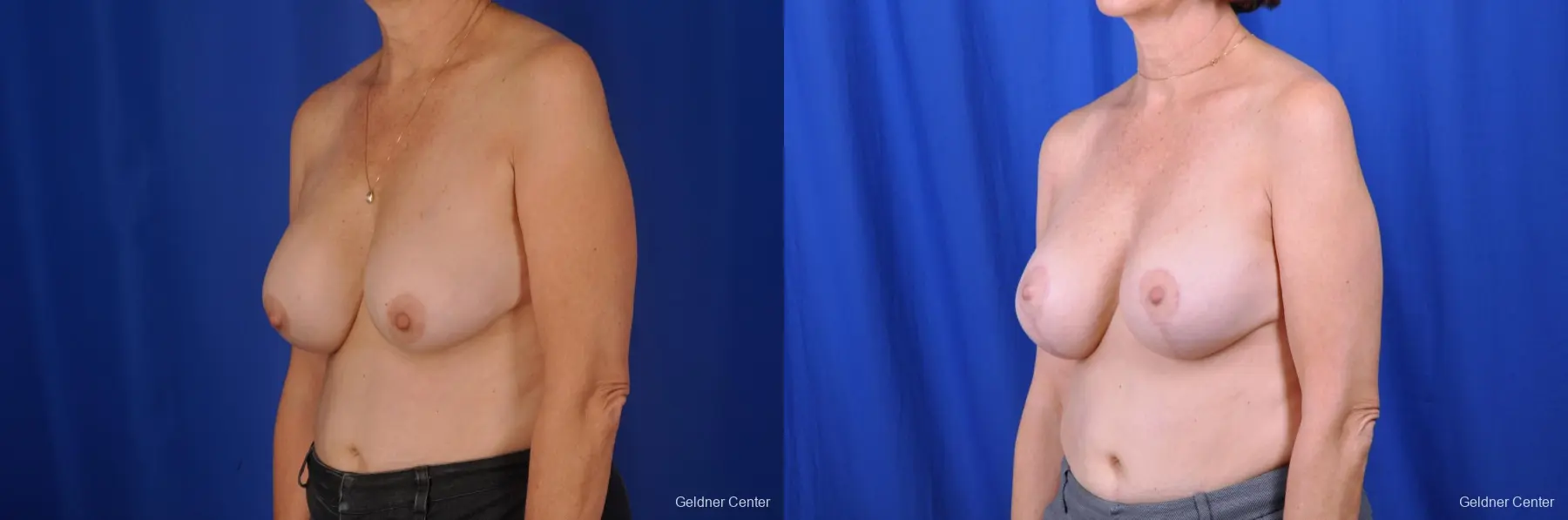 Breast Augmentation Lake Shore Dr, Chicago 2057 - Before and After 4