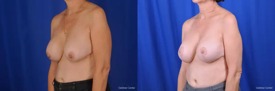 Breast Augmentation Lake Shore Dr, Chicago 2057 - Before and After 4