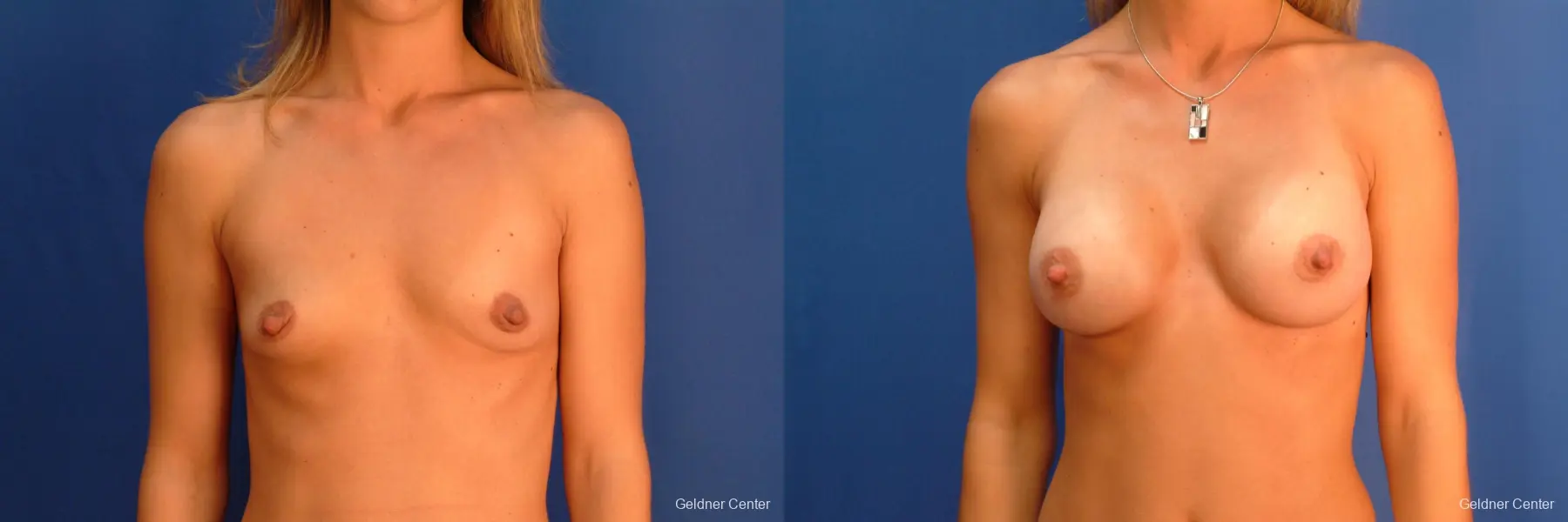 Breast Augmentation Hinsdale, Chicago 2510 - Before and After