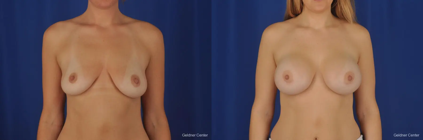 Chicago Breast Augmentation 2374 - Before and After 1