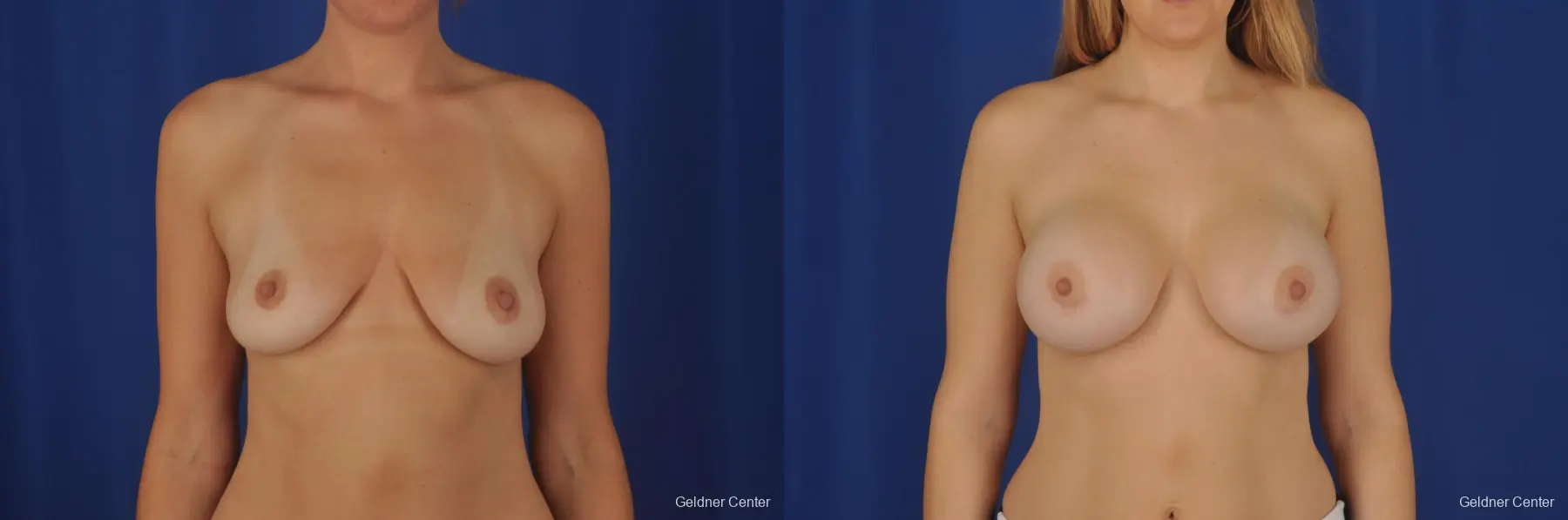 Chicago Breast Augmentation 2374 - Before and After