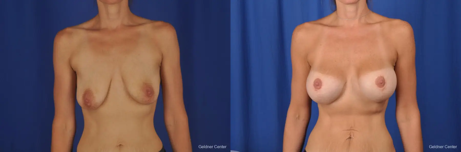 Biplanar Subpectoral Breast augmentation with Vertical Mastopexy 400cc - Before and After