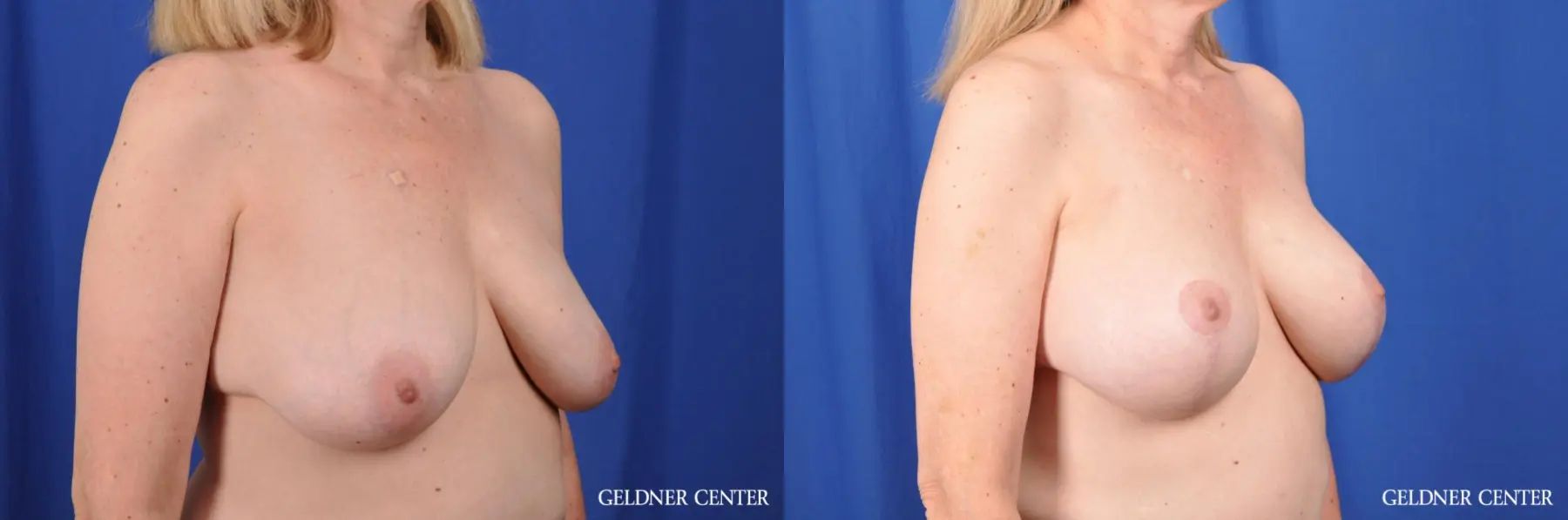 Breast Augmentation: Patient 168 - Before and After 2