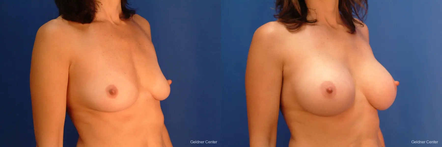 Breast Augmentation Streeterville, Chicago 2437 - Before and After 3