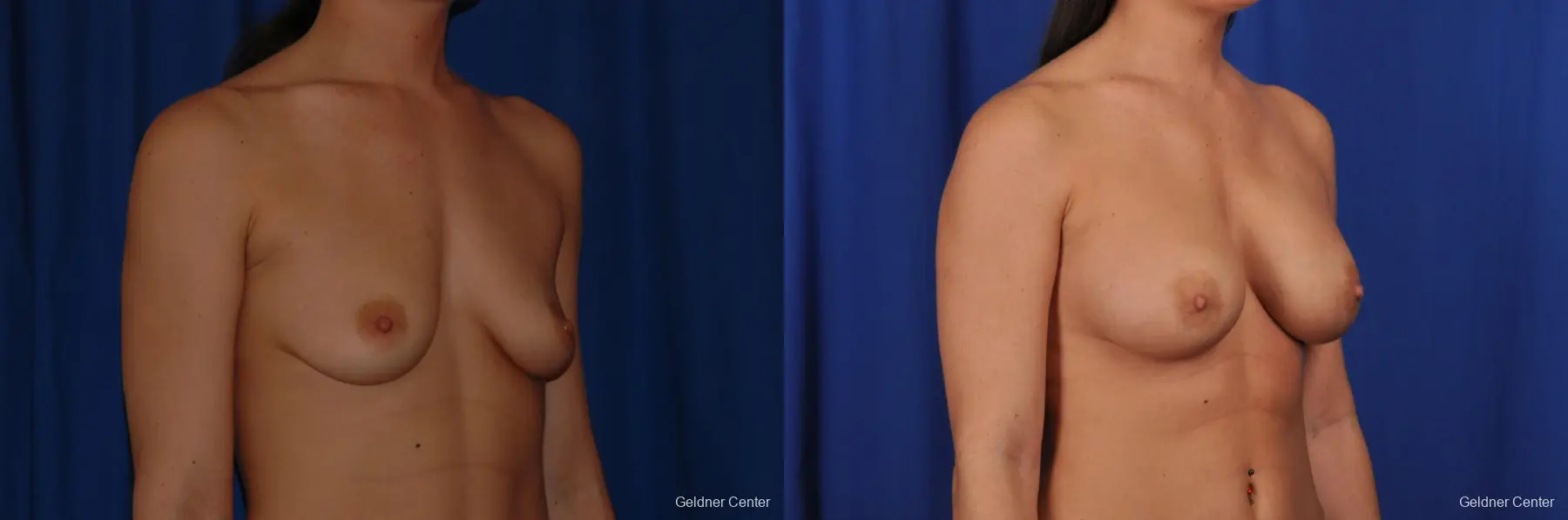 Breast Augmentation Streeterville, Chicago 2071 - Before and After 3