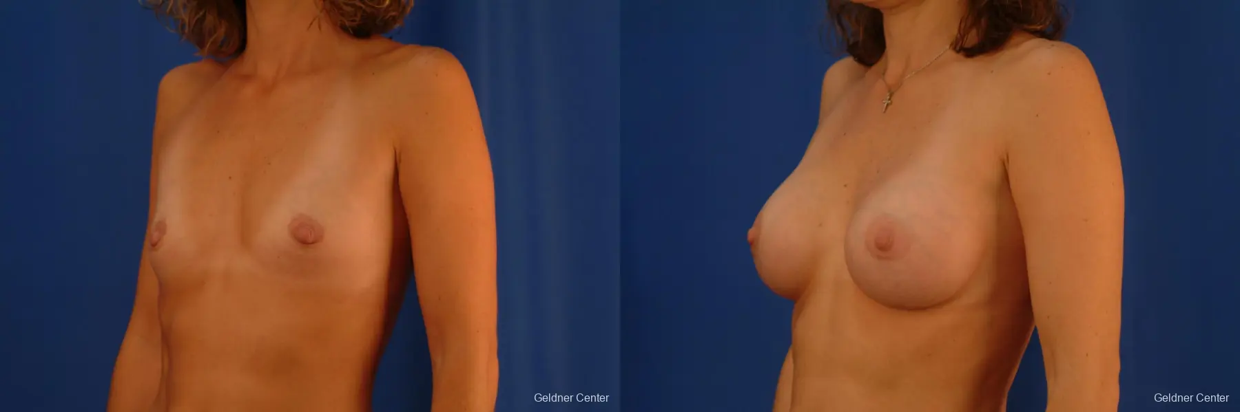 Chicago Breast Augmentation 2442 - Before and After 4