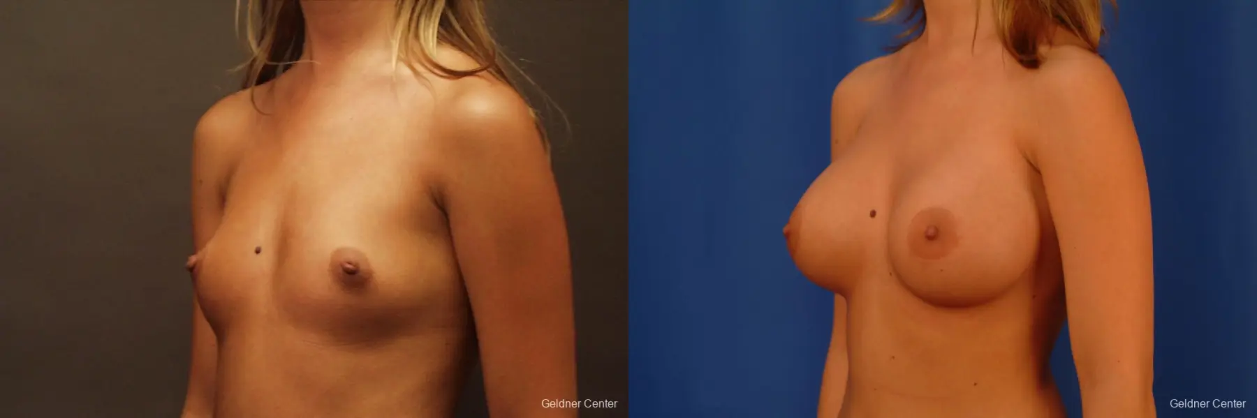 Breast Augmentation Lake Shore Dr, Chicago 2533 - Before and After 4