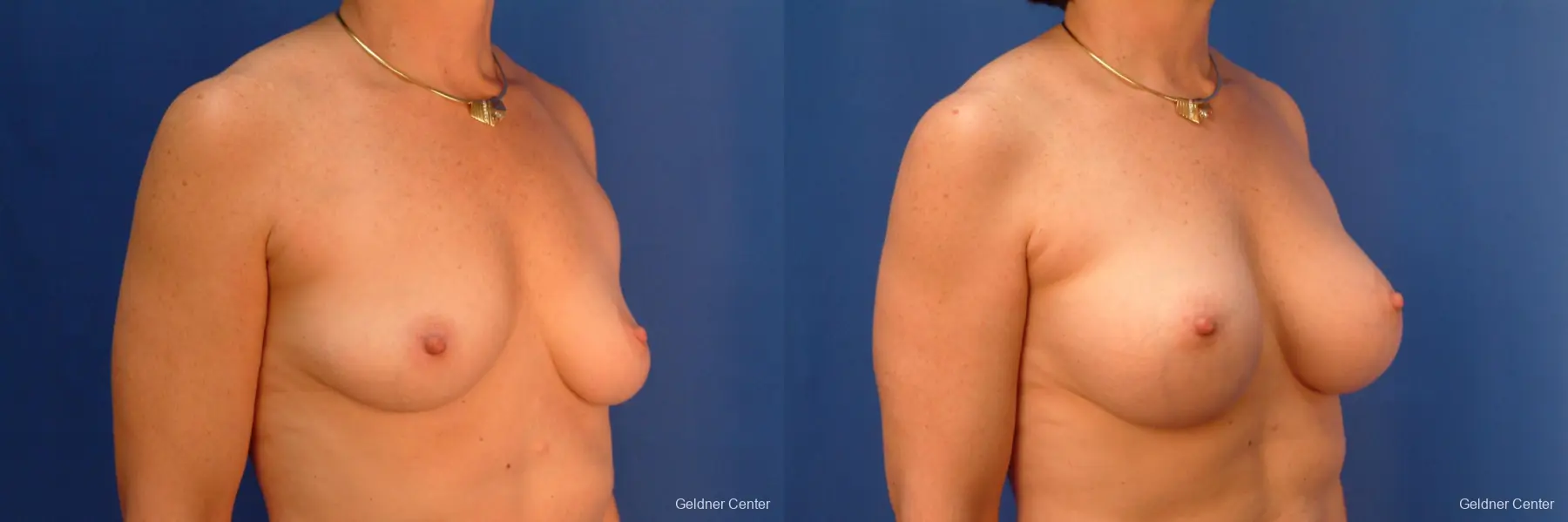 Breast Augmentation Hinsdale, Chicago 2541 - Before and After 3