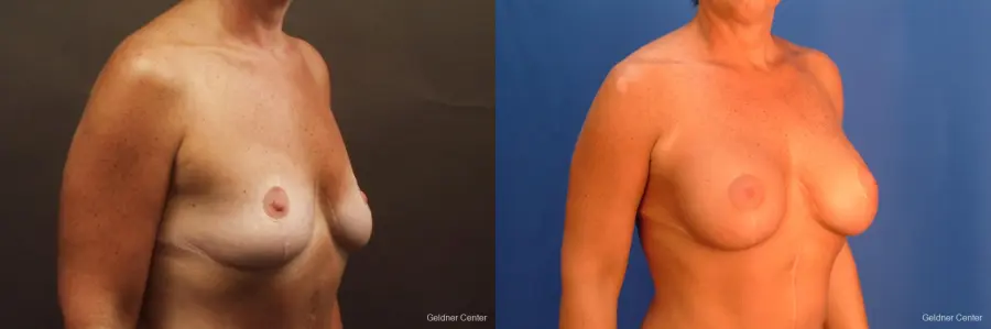 Chicago Breast Augmentation 2524 - Before and After 2