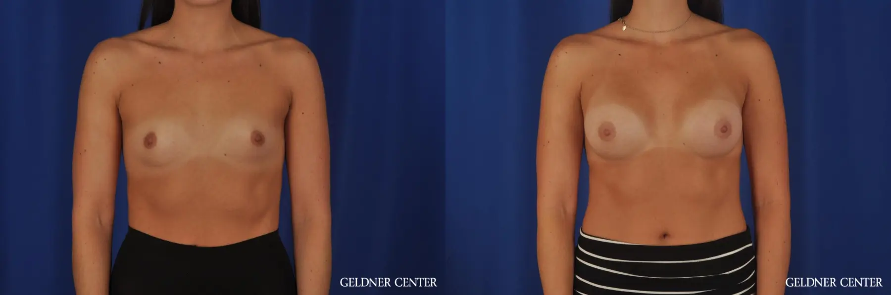 Breast Augmentation Hinsdale, 4290 - Before and After