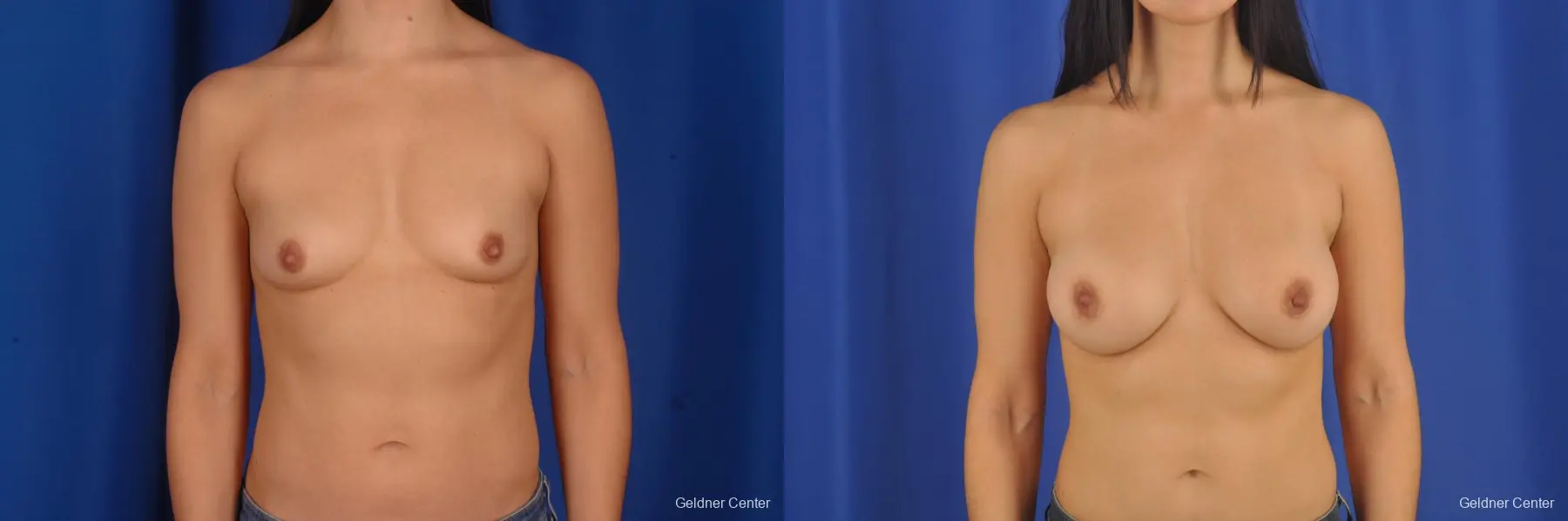 Breast Augmentation Hinsdale, Chicago 2299 - Before and After