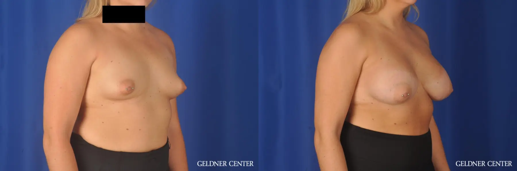 Breast Augmentation: Patient 180 - Before and After 2