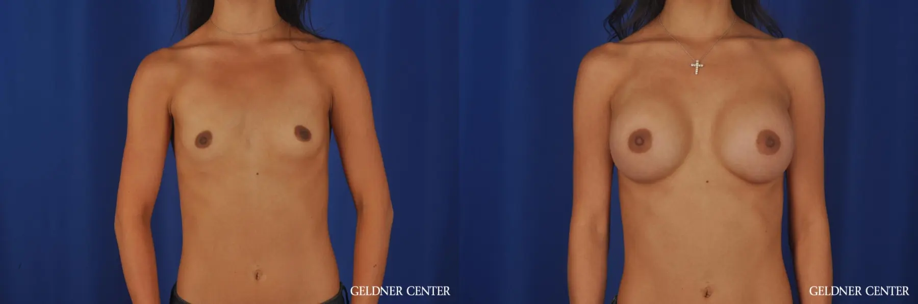 Breast Augmentation Lake Shore Dr, Chicago 5545 - Before and After