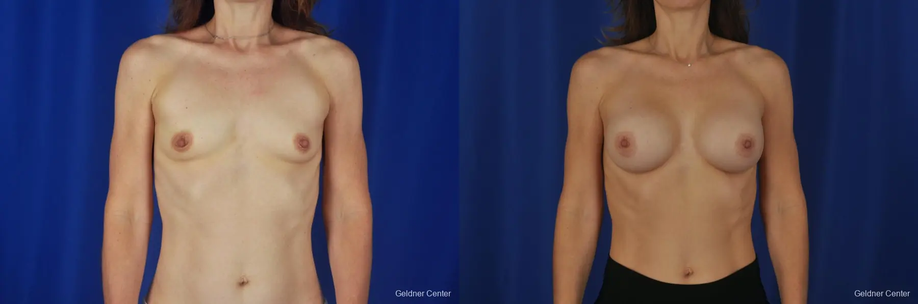 Chicago Breast Augmentation Natrelle Smooth Gel Implants 2067 - Before and After 1