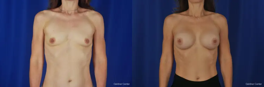 Chicago Breast Augmentation Natrelle Smooth Gel Implants 2067 - Before and After