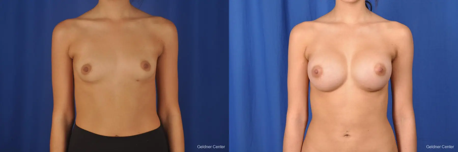 Breast Augmentation Streeterville, Chicago 8616 - Before and After 1