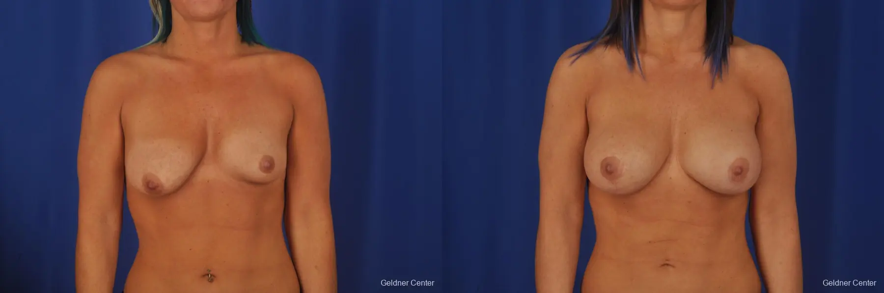 Breast Augmentation Hinsdale, Chicago 2335 - Before and After