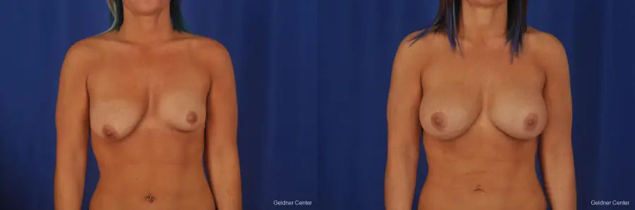 Breast Augmentation Hinsdale, Chicago 2335 - Before and After 1