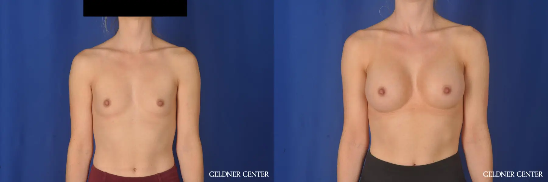 Breast Augmentation Hinsdale, Chicago 11860 - Before and After
