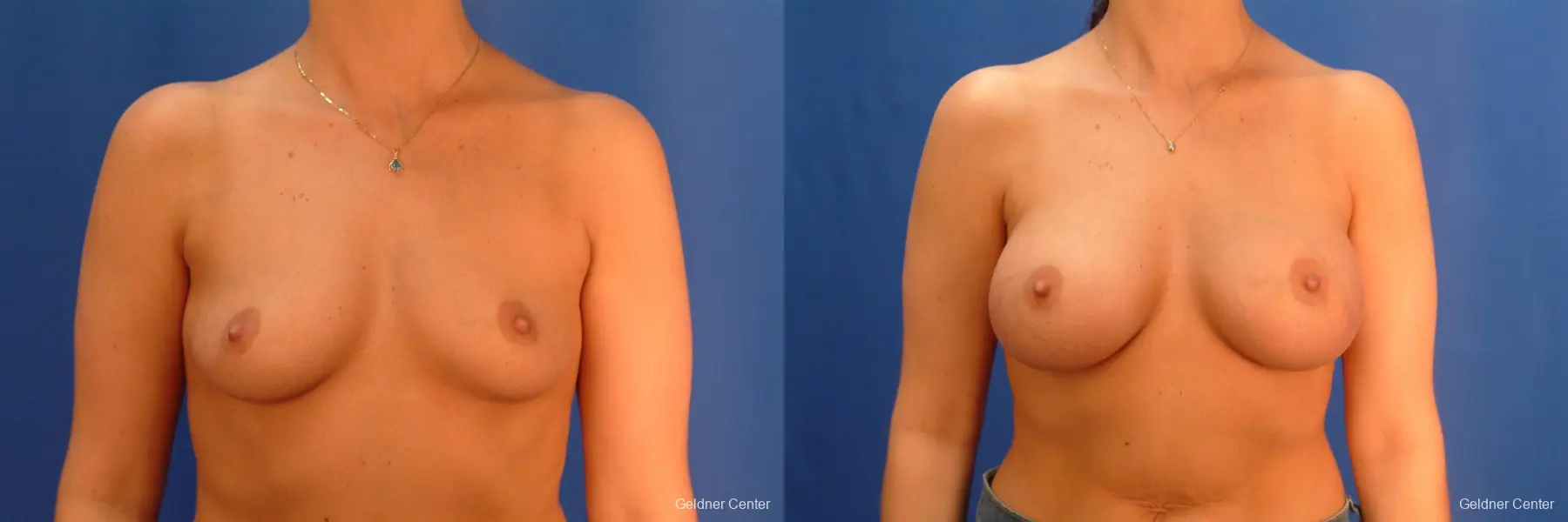 Chicago Breast Augmentation 2432 - Before and After 1