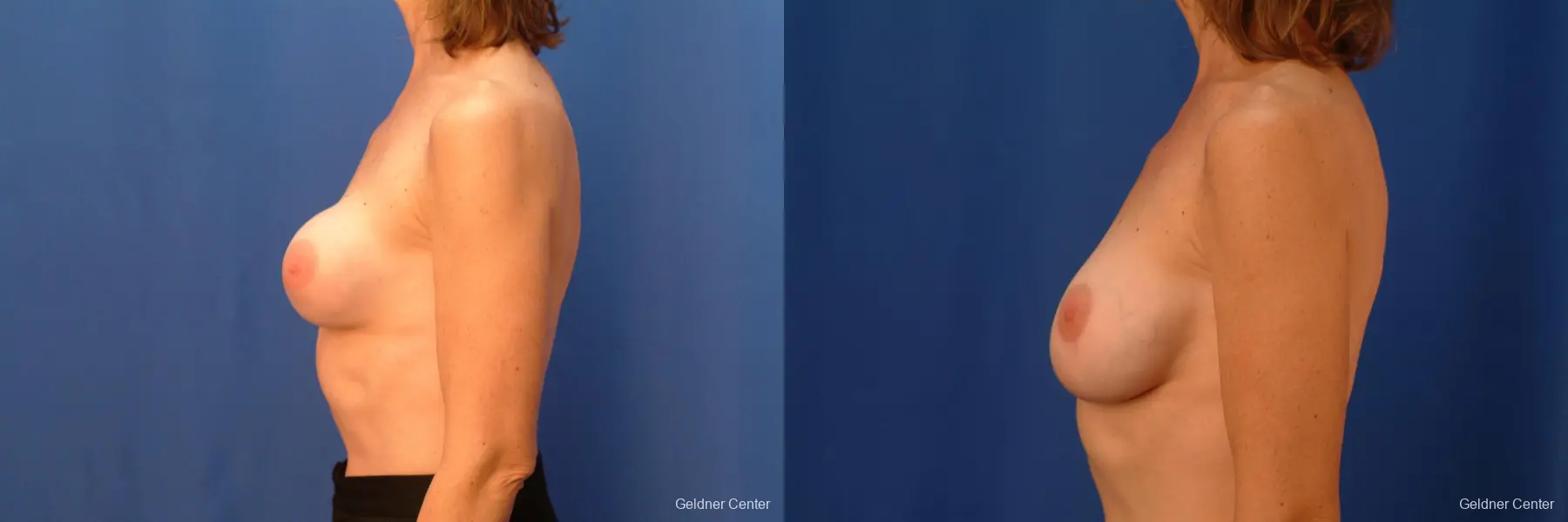 Chicago Breast Augmentation 2444 - Before and After 3