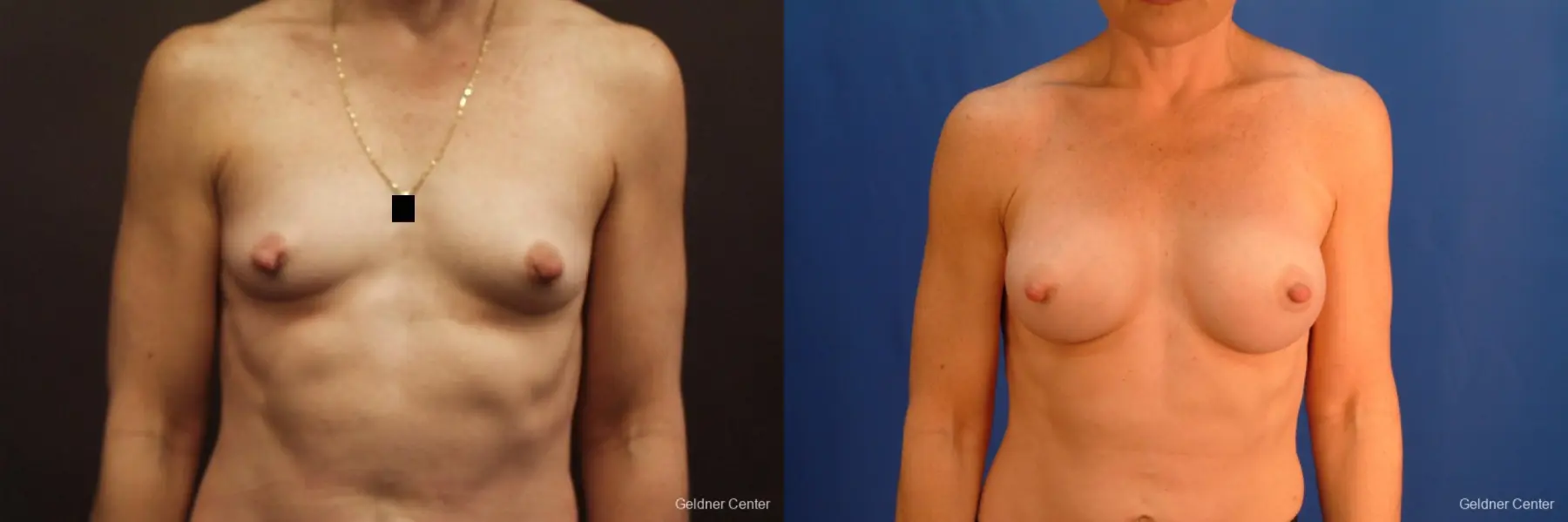 Chicago Breast Augmentation 2635 - Before and After 1