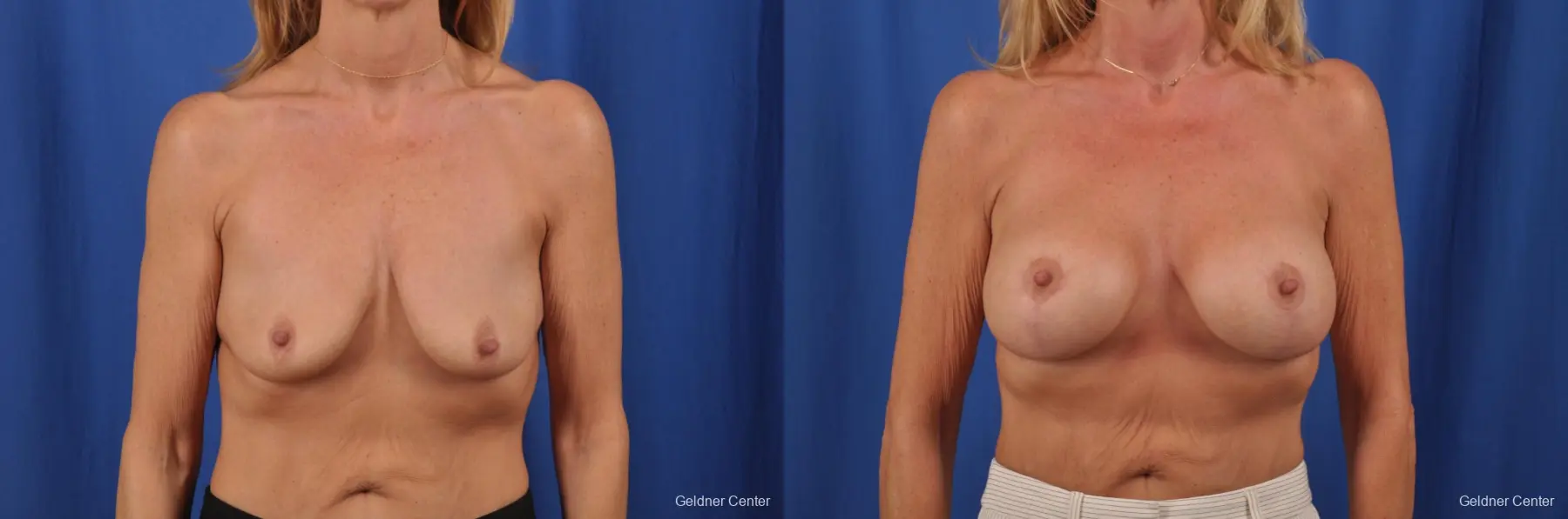 Bilateral Subpectoral biplanar breast augmentation with vertical mastopexy 350 cc - Before and After