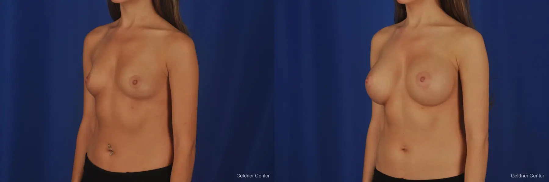 Breast Augmentation Hinsdale, Chicago 2373 - Before and After 4